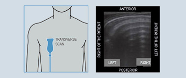 Lung Ultrasound (LUS) in Critical Care