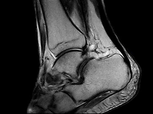 O-scan - Ankle FSE T2 Sagittal