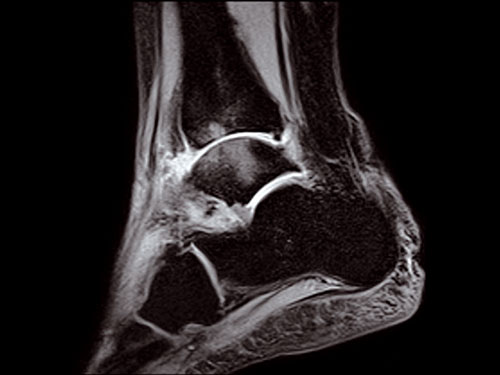 O-scan - Ankle STIR Sagittal