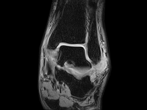 O-scan - Ankle XBONE Coronal