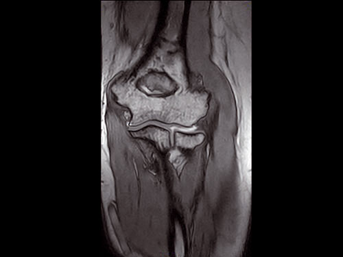 O-scan - Elbow 3D SHARC Coronal