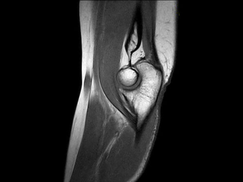 O-scan - Elbow SpinEcho T1 Sagittal