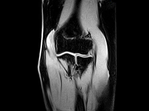 O-scan - Elbow XBONE Coronal