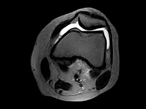 O-scan - Knee FSE T2 Axial