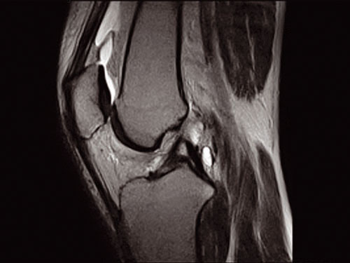 O-scan - Knee FSE T2 Sagittal