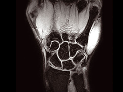 O-scan - Wrist XBone Coronal